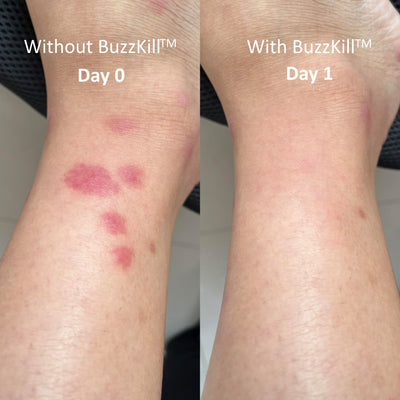 BuzzKill™ — Non-Toxic Mosquito Repellent & Bite Healer