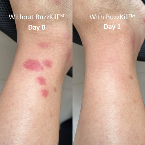 BuzzKill™ — Non-Toxic Mosquito Repellent & Bite Healer