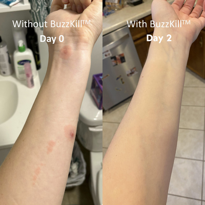 BuzzKill™ — Non-Toxic Mosquito Repellent & Bite Healer