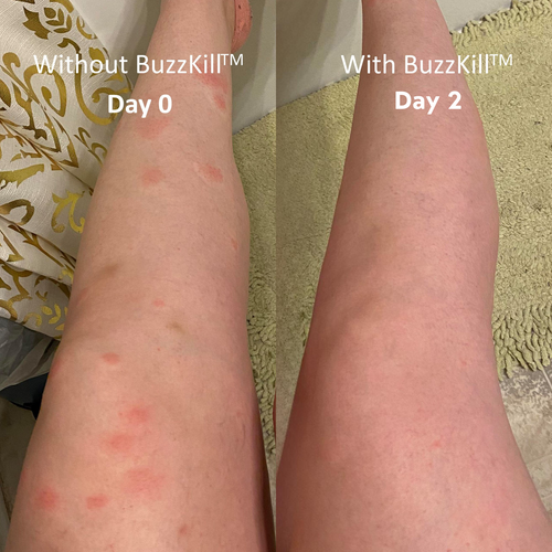 BuzzKill™ — Non-Toxic Mosquito Repellent & Bite Healer