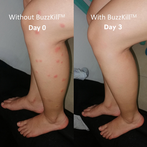 BuzzKill™ — Non-Toxic Mosquito Repellent & Bite Healer