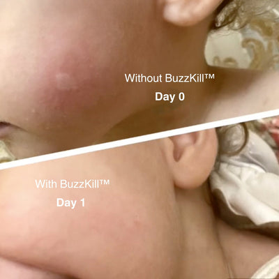 BuzzKill™ — Non-Toxic Mosquito Repellent & Bite Healer